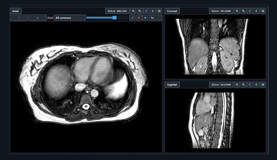 A radiotherapy planning workstation showing CT and MRI slices beside a structure-contouring panel.